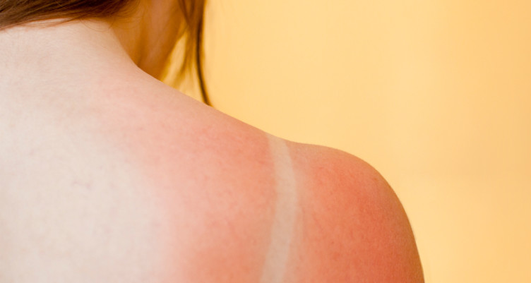 sun burn