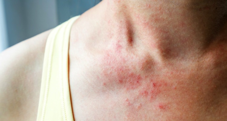 Keto Rash: What to Do When Low-Carb Eating Makes You Itchy