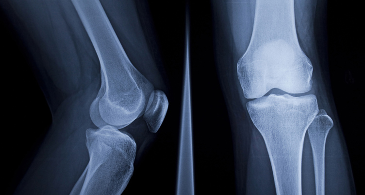 X-ray of knees