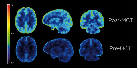 A PET scan of a brain before and after consuming Bulletproof Brain Octane C8 MCT Oil