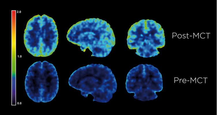 Study Shows How Bulletproof Brain Octane C8 MCT Oil Powers the Brain