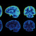 A PET scan of a brain before and after consuming Bulletproof Brain Octane C8 MCT Oil