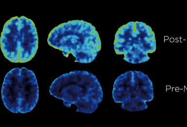 A PET scan of a brain before and after consuming Bulletproof Brain Octane C8 MCT Oil