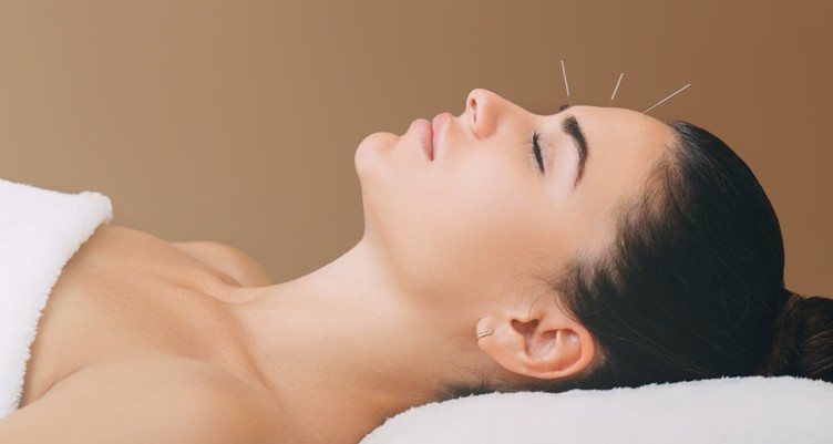 Woman receiving acupuncture treatment for a headache.