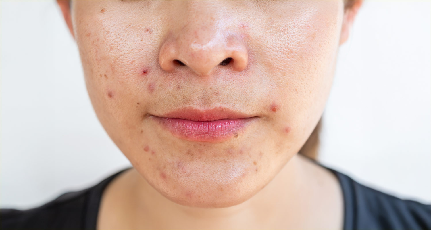 person with acne